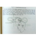 Scalp Acupuncture and Clinical Cases (cod C107)